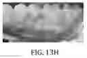 Fig. 22 - GUIDED ENDODONTIC MICRO-SURGERY (EMS) WITH TREPHINE BURS