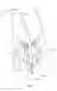 Fig. 02 - Method of transvascular prosthetic chordae tendinae implantation