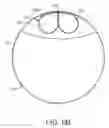 Fig. 08 - Stent grafts and methods of use for treating aneurysms