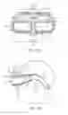 Fig. 03 - Improved Systems for Augmented Reality Visual Aids and Tools