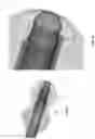 Fig. 06 - Method and apparatus for manipulating the side wall of a body lumen or body cavity so as to provide increased visualization of the same and/or increased access to the same, and/or for stabilizing instruments relative to the same