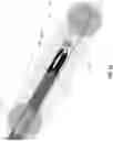 Fig. 33 - Method and apparatus for manipulating the side wall of a body lumen or body cavity so as to provide increased visualization of the same and/or increased access to the same, and/or for stabilizing instruments relative to the same