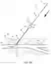 Fig. 08 - Apparatus and methods for sealing a vascular puncture