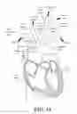 Fig. 02 - Implantable damping devices for treating dementia and associated systems and methods of use