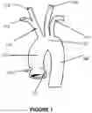 Fig. 02 - Thrombus retrieval stents and methods of using for treatment of ischemic stroke