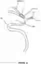 Fig. 03 - Thrombus retrieval stents and methods of using for treatment of ischemic stroke