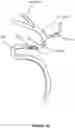 Fig. 04 - Thrombus retrieval stents and methods of using for treatment of ischemic stroke