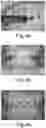 Fig. 06 - Orthodontic device for overbite correction