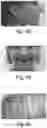 Fig. 07 - Orthodontic device for overbite correction