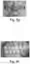 Fig. 09 - Orthodontic device for overbite correction