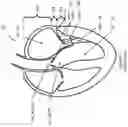 Fig. 02 - Multi-level cardiac implant