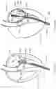 Fig. 41 - Multi-level cardiac implant