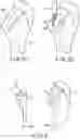 Fig. 09 - METHOD FOR REVISION ARTHROPLASTY