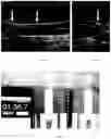 Fig. 03 - Devices and methods for injectable vascular sclerofoams using a carrier matrix and uses thereof