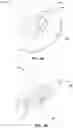 Fig. 06 - Fixation device for medical device retention