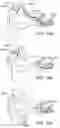 Fig. 22 - SYSTEMS AND METHODS FOR IMPLANTABLE LEADLESS TISSUE STIMULATION
