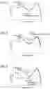Fig. 03 - Welding method of diffusion bonded structure