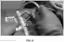 Fig. 07 - Live 3D holographic guidance and navigation for performing interventional procedures