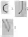 Fig. 07 - Method and apparatus for manipulating the side wall of a body lumen or body cavity so as to provide increased visualization of the same and/or increased access to the same, and/or for stabilizing instruments relative to the same