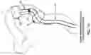 Fig. 85 - Method and apparatus for manipulating the side wall of a body lumen or body cavity so as to provide increased visualization of the same and/or increased access to the same, and/or for stabilizing instruments relative to the same