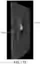 Fig. 22 - Volume analysis and display of information in optical coherence tomography angiography