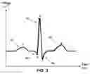 Fig. 03 - APPARATUS AND METHOD FOR CALCULATING BLOOD PRESSURE USING DIGITAL ECG VOLTAGE COORDINATE VALUES