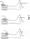 Fig. 08 - Feedback device with stimulation of sensory nerves for improved balance control