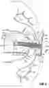 Fig. 06 - Universal linear surgical stapling buttress