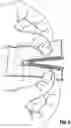 Fig. 07 - Universal linear surgical stapling buttress