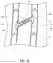 Fig. 02 - Treatment of incompetent vessels