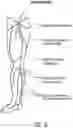 Fig. 04 - Treatment of incompetent vessels