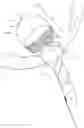 Fig. 01 - INTRA-ANEURYSMAL DEVICE