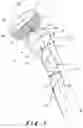 Fig. 02 - INTRA-ANEURYSMAL DEVICE