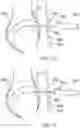 Fig. 06 - Tissue incision device