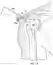 Fig. 11 - Surgical device deployment apparatuses