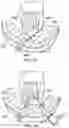 Fig. 27 - Surgical device deployment apparatuses