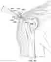 Fig. 38 - Surgical device deployment apparatuses