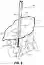 Fig. 08 - Anchoring device with extended tabs