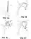 Fig. 06 - Systems and methods for intramedullary nail implantation