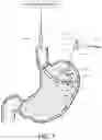 Fig. 08 - Medical ablation devices and methods