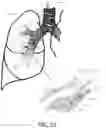 Fig. 16 - Medical ablation devices and methods