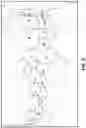 Fig. 09 - Automatic ectopic teeth detection on scan