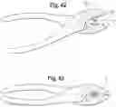 Fig. 16 - Orthodontic appliance and method for moving teeth