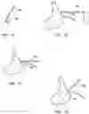 Fig. 07 - Systems and methods for reshaping a heart valve