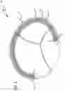 Fig. 06 - CIRCUMFERENTIALLY CONSTRICTIVE ANNULOPLASTY RING