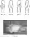 Fig. 02 - Device and associated percutaneous minimally invasive method for creating a venous valve