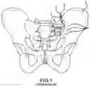 Fig. 02 - Spinopelvic fixation technology
