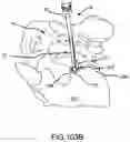 Fig. 72 - Spinopelvic fixation technology