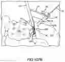Fig. 77 - Spinopelvic fixation technology