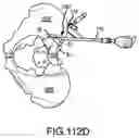 Fig. 85 - Spinopelvic fixation technology